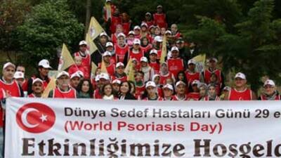 125 milyon kişi sedef hastası