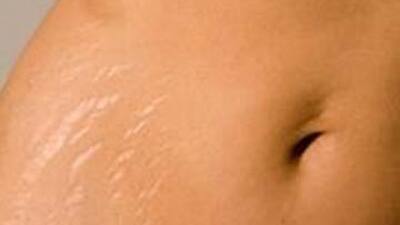 Cilt çatlaklarından nasıl kurtulunur?