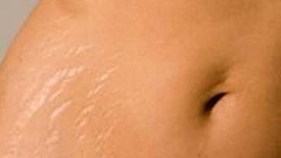 Cilt çatlaklarından nasıl kurtulunur?