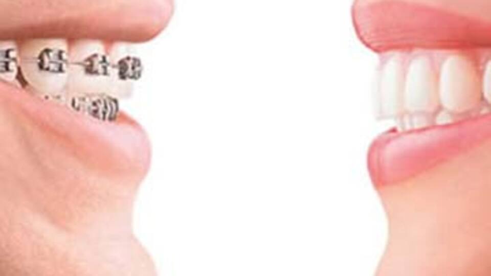 Diş telleri mi? Hiç korkmayın!