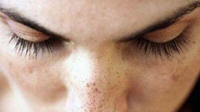 Cilt lekelerine çözüm bulundu mu?