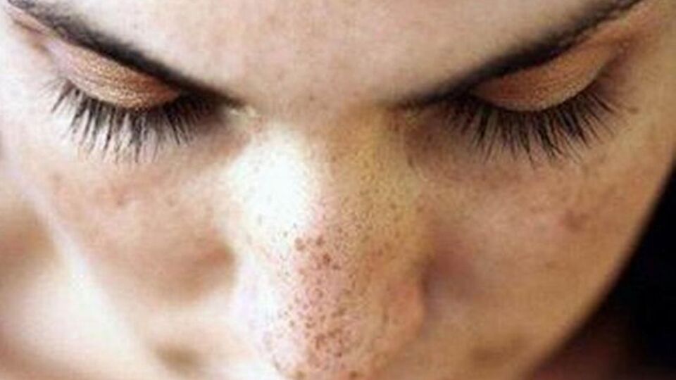 Cilt lekelerine çözüm bulundu mu?