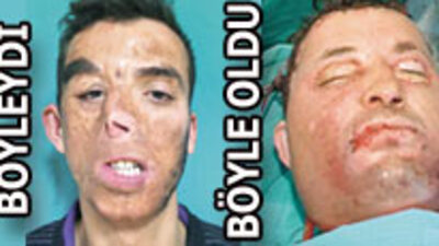 Türkiye'nin ilk nakil yüzü! VİDEO