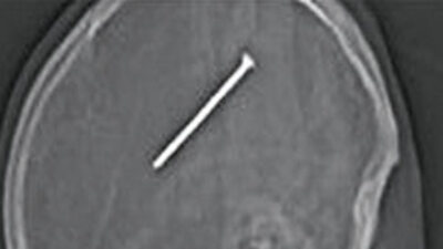 Kafasına 7.5 santimlik çivi girdi, farketmedi