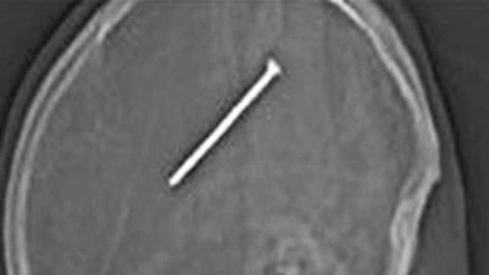 Kafasına 7.5 santimlik çivi girdi, farketmedi