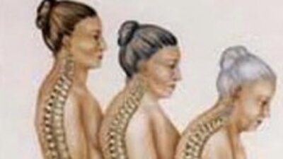Osteoporozu doğru tanıyın