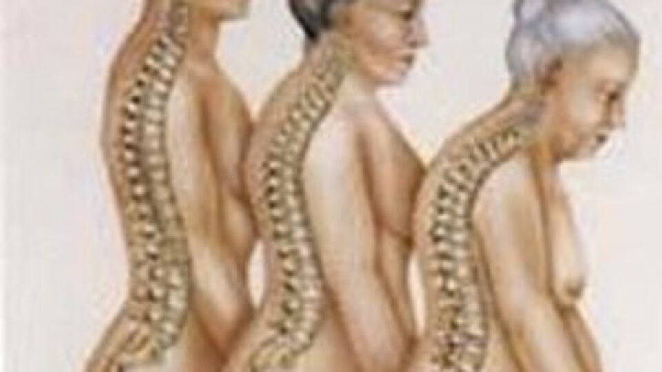 Osteoporozu doğru tanıyın