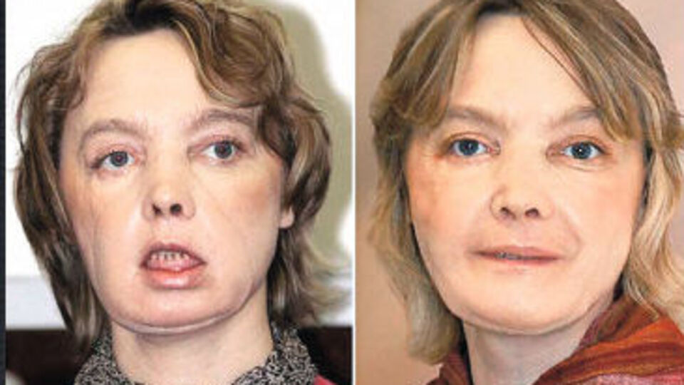 Yüz naklinin bilinmeyen yüzü