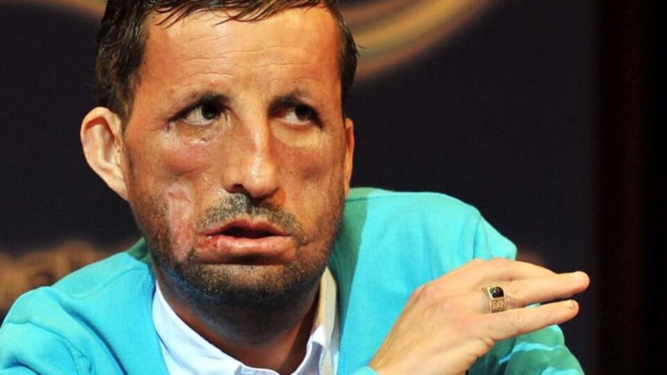 Yüzünde 'ölüm izi' olan adam