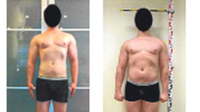 Ameliyatla 15 cm uzadı!