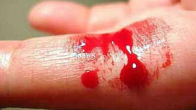 Bugün "Dünya Hemofili Günü"