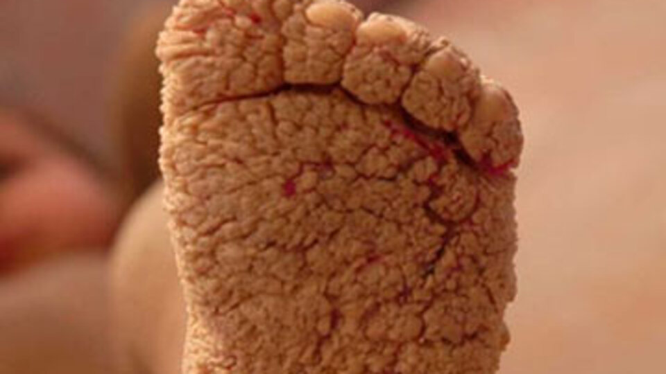 Timsah derisinden nasıl kurtuldu?