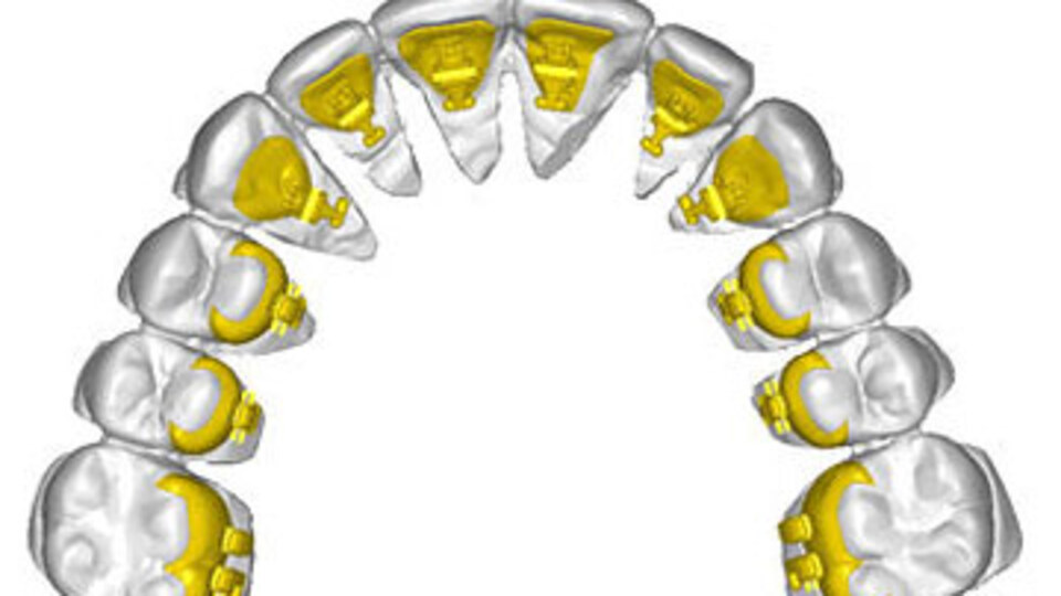 Çocuklara müjde: Görünmeyen diş teli