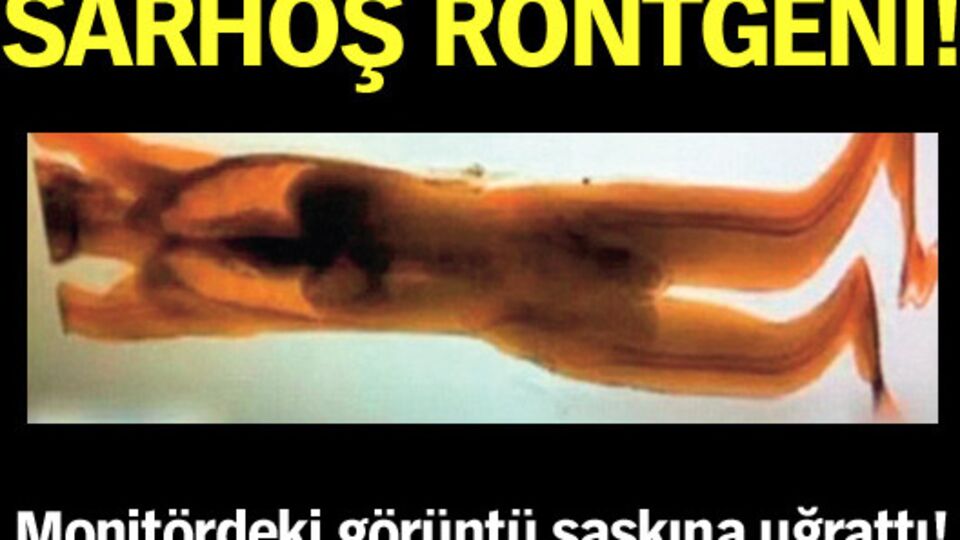 Sarhoşun röntgeni!