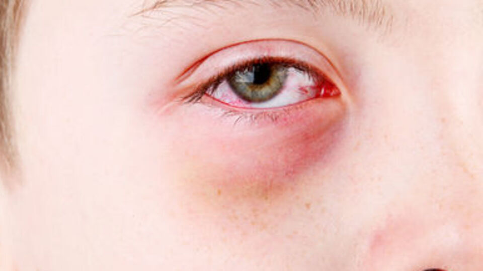 Göz alerjisi astigmata yol açabilir!