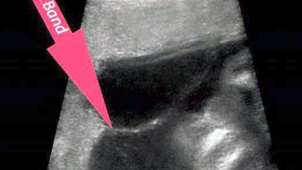 17 haftalık bebeğe anne karnında ameliyat
