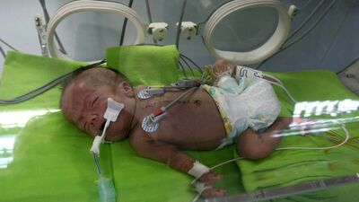 1 kilo 800 gramlık yaşam savaşı!