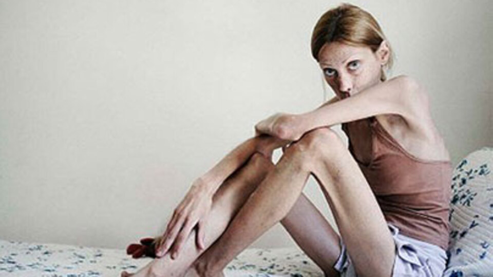 Anoreksiya genç kızları nasıl tuzağa düşürüyor?