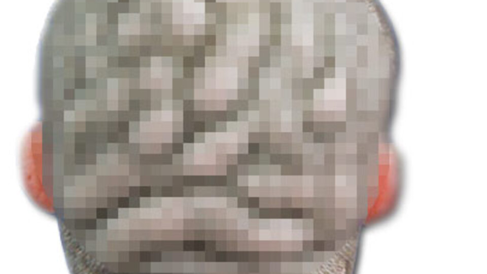 Kafa derisini görenler hayrete düşüyor!