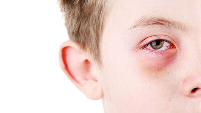 Göz kanlanması neyin belirtisi?