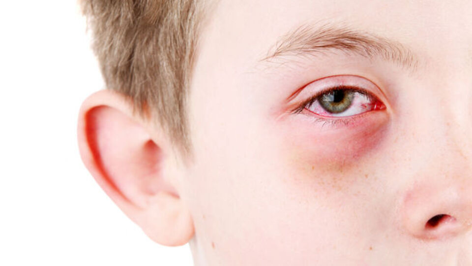 Göz kanlanması neyin belirtisi?