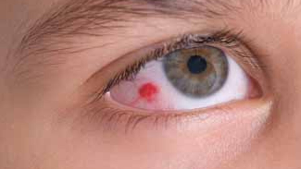 Göz mantarı kör edebilir!