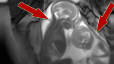 Anne karnındaki büyük kavga!