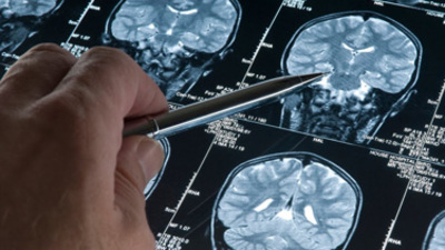 Alzheimer'ı yavaşlatan beslenme şekli!