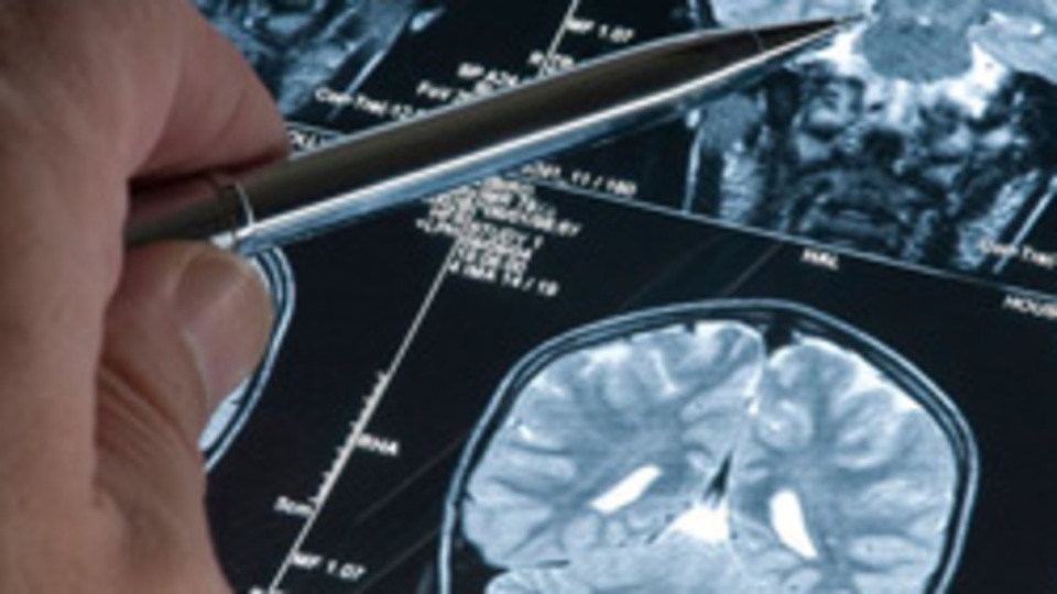 Alzheimer'ı yavaşlatan beslenme şekli!