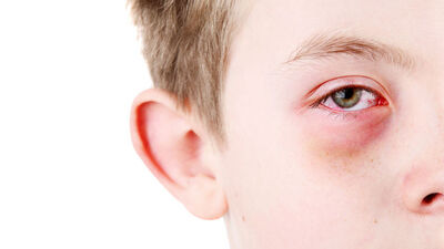 Gözü çapaklananlar dikkat!