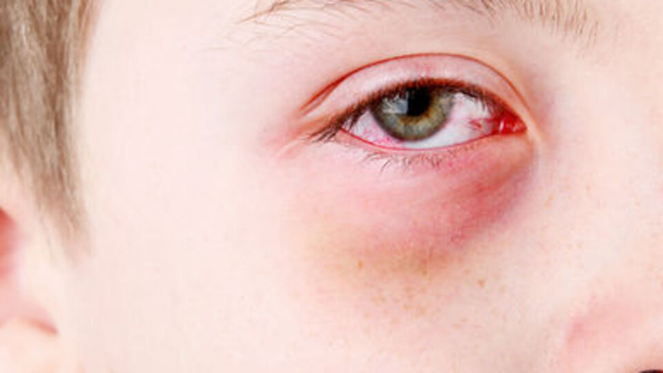 Gözü çapaklananlar dikkat!