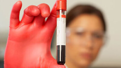 Kan testiyle Alzheimer teşhisi konacak!