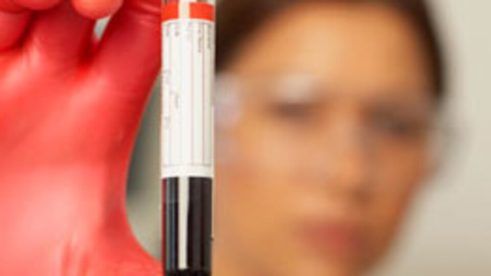 Kan testiyle Alzheimer teşhisi konacak!