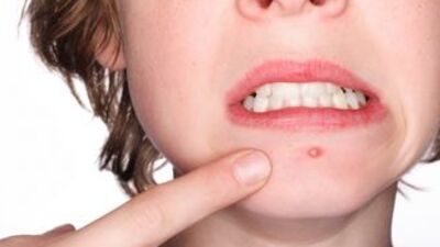 Akne tedavisinde geç kalmayın!