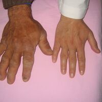 Büyüme hastalığını küçümsemeyin!