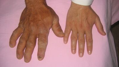 Büyüme hastalığını küçümsemeyin!