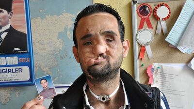 O da yüz nakli olmak istiyor