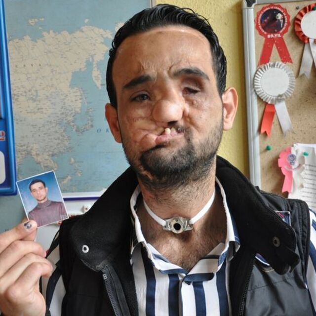 O da yüz nakli olmak istiyor