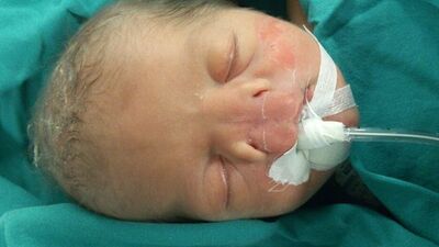 Burunsuz bebek ilk kez nefes aldı!