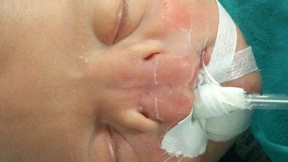 Burunsuz bebek ilk kez nefes aldı!