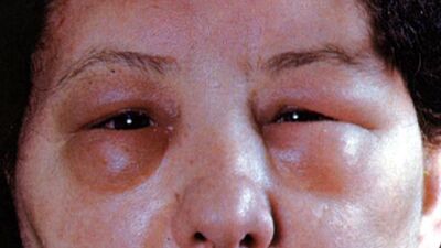 2 bin 700 kişi tanı konmazsa ölebilir