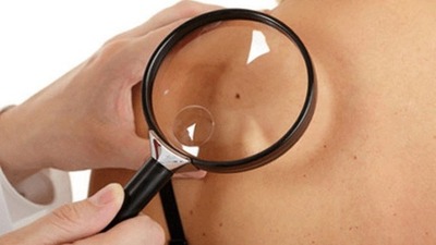 Kanserli ben nasıl anlaşılır?