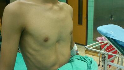 Göğüste oluşan çukura dikkat