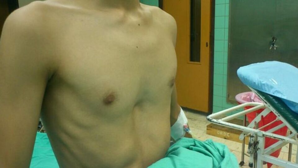 Göğüste oluşan çukura dikkat