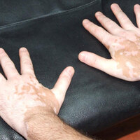 Bu hastalık sandığınız kadar korkutucu değil