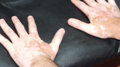 Bu hastalık sandığınız kadar korkutucu değil