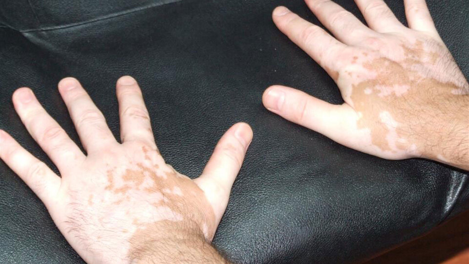 Bu hastalık sandığınız kadar korkutucu değil