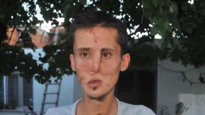 Yüz nakli sevinci iki saat sürdü