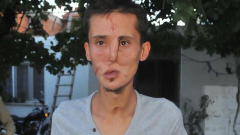 Yüz nakli sevinci iki saat sürdü