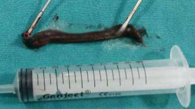 Gırtlağından canlı sülük çıkarıldı!